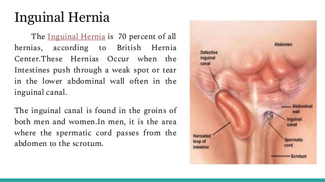inguinal hiatal hernia treatment