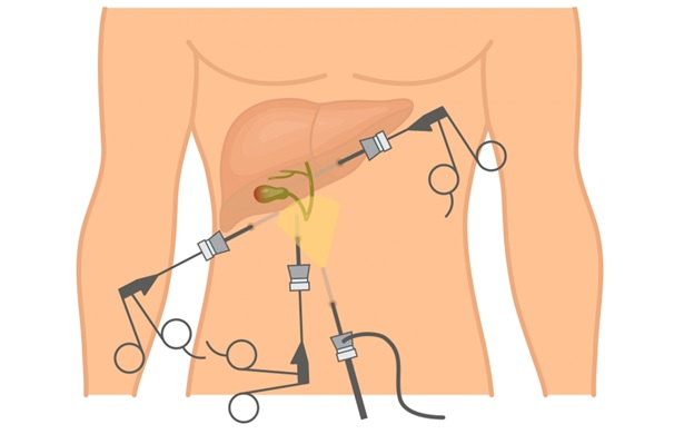hernia laparoscopic surgery cost