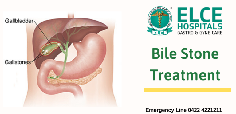 Gall stone treatment