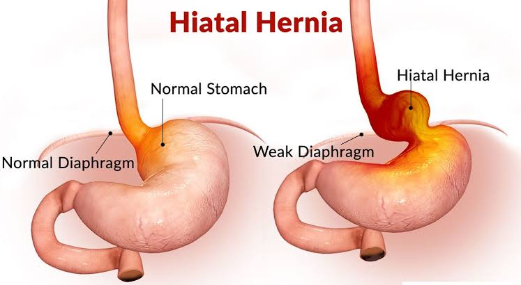 laparoscopic hiatal hernia repair