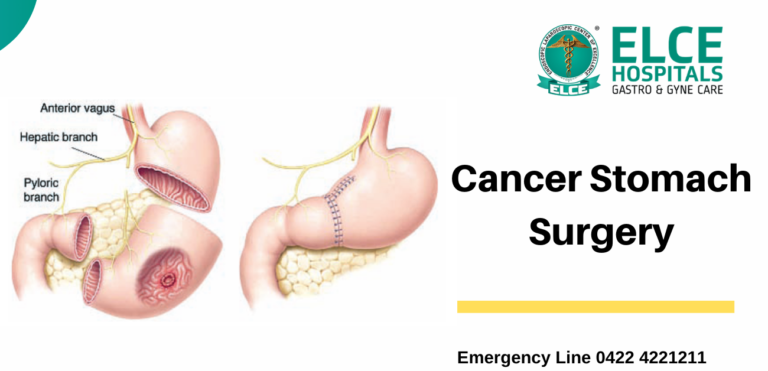 stomach cancer treatment in coimbatore