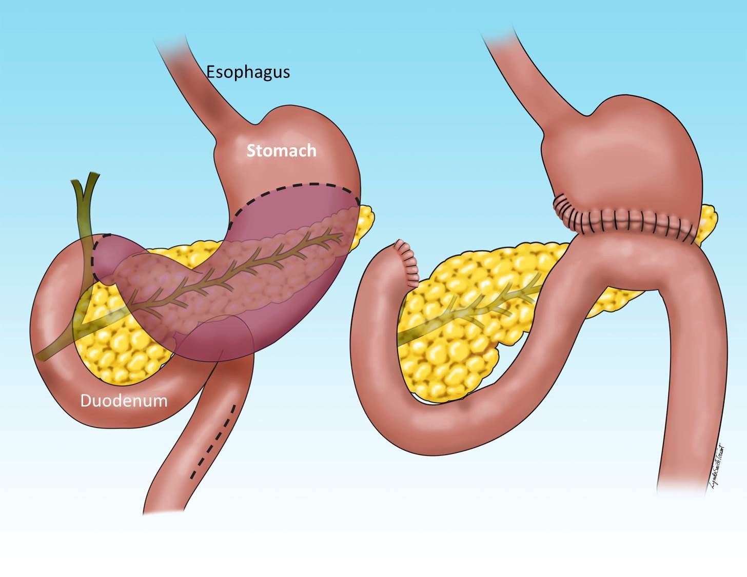 Surgery for Cancer Stomach