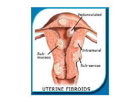Best Obstetrician-Gynecologists for UTERINE FIBROIDS IN COIMBATORE